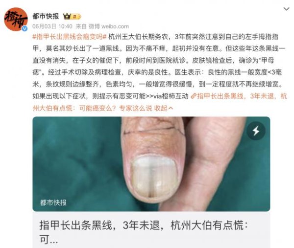 涨配资 医生提醒：指甲出现这个变化，可能是癌变！别不当回事！